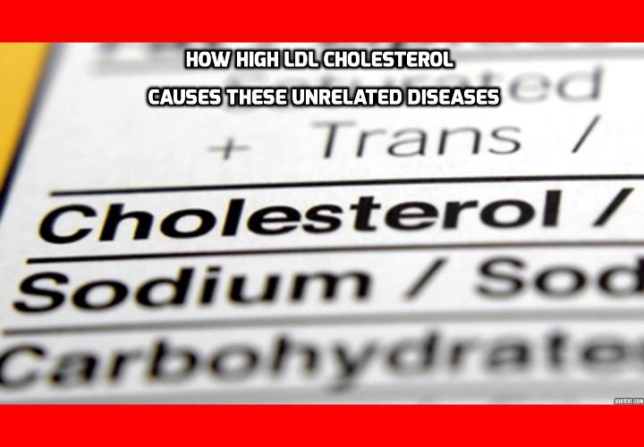 How High LDL Cholesterol Causes These Unrelated Diseases - When we talk about high LDL cholesterol, it is usually in terms of it causing coronary artery disease, heart attacks, and strokes. A new study authored by a large multinational team of researchers has just appeared in the Proceedings of the National Academy of Sciences and reveals that high LDL cholesterol can also put you at risk of a very different disease.