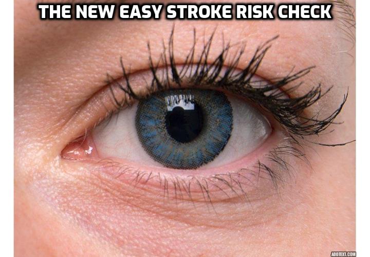 What is the Best Way to Clear Out Your 93% Cholesterol Clogged Arteries?  Clear Out Your 93% Cholesterol Clogged Arteries - The New Easy Stroke Risk Check. It just got easier to identify imminent stroke, according to a recent study from the Singapore Eye Research Institute. So easy in fact, that all you have to do is say “cheese”. The researchers behind the study have discovered an amazing new way to identify whether or not a person is headed for a stroke without any invasive tests, and it’s as simple as taking a photograph.