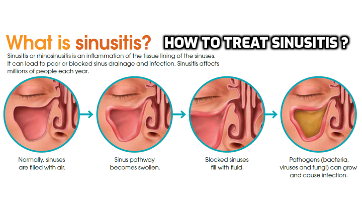 best otc meds for sinus infection