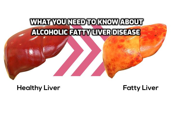 Here is What You Need to Know about Alcoholic Fatty Liver Disease - There are several ways of treating alcoholic fatty liver disease, but the most important method is to stop drinking alcohol. This really does mean the total elimination of alcohol - all beer, wine, hard drinks, tonics and everything else that contains alcohol. 