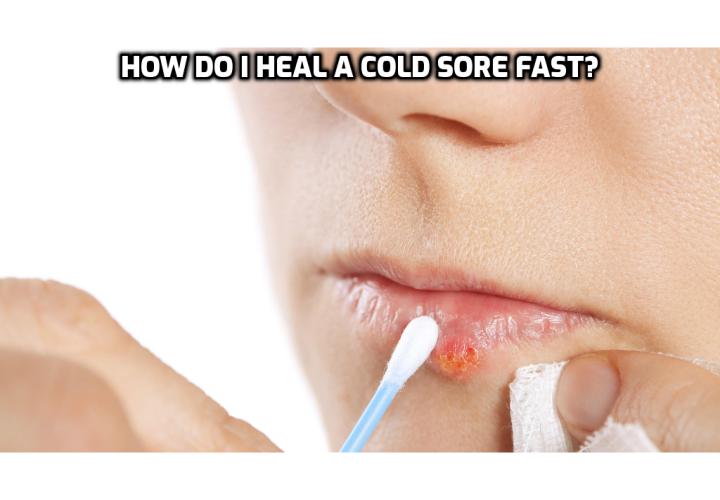 Cure Cold Sores – How Do I Heal a Cold Sore Fast? The technical name for cold sore/fever blister is Herpes Simplex Virus type 1 (HSV-1). This virus is transmitted through humans in the form of saliva, oral contact, dead skin, utensils, etc. Humans suffer from cold sores because of unhealthy lifestyles, oxygen deficient bodies, acidity, stress and strain, and excessive exposure to sun, consumption of junk food, chocolates, poor immune system, etc. To learn how to cure cold sores, read on to find out more.