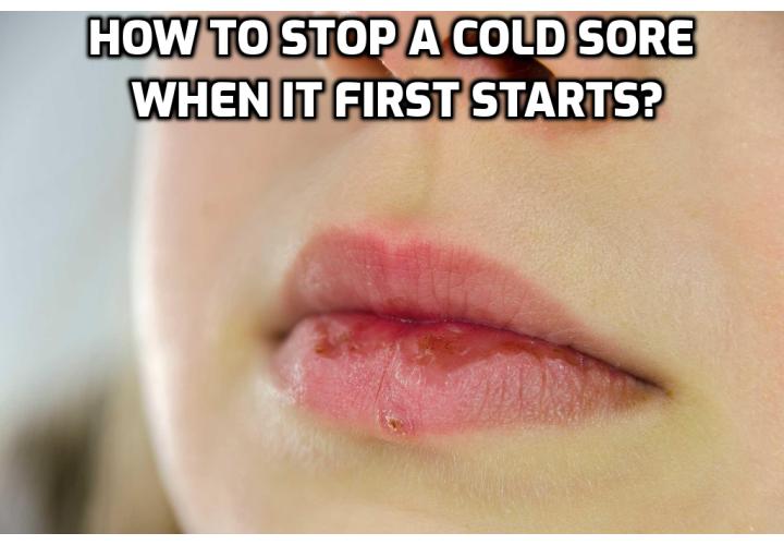 Prevent Cold Sores – How to Stop a Cold Sore When It First Starts? A cold sore is also called a fever blister; its technical name is herpes simplex virus. It is a contagious virus and it spreads from one person to another very quickly. We suffer from cold sores because of our inability to stay healthy. Temporary treatment is available for this virus but there is no permanent cure yet. It is therefore important to learn how to prevent cold sores. 