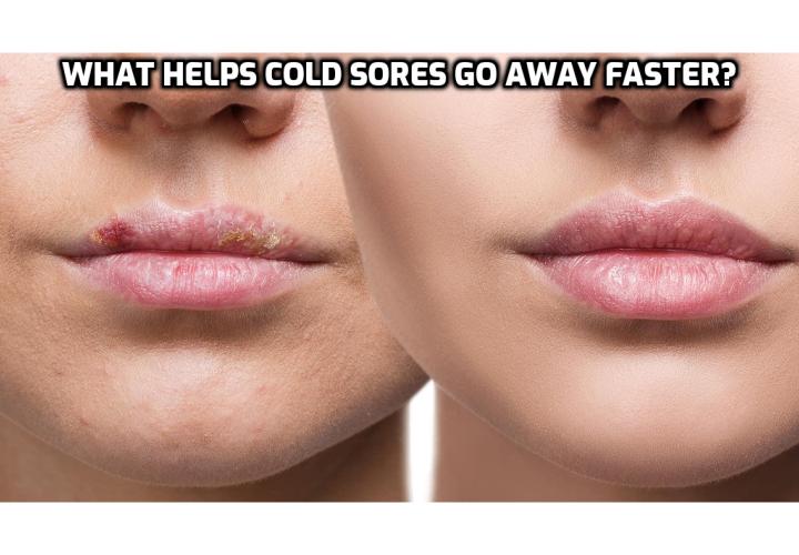 natural-cold-sores-treatment-what-helps-cold-sores-go-away-faster