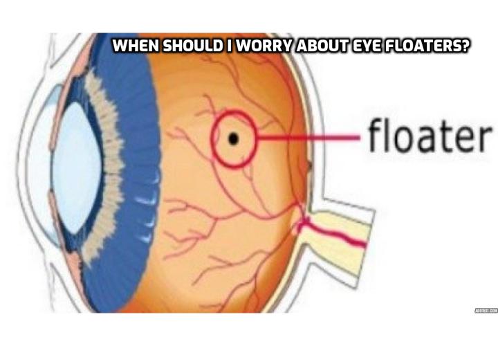 Eye Floaters Causes and Cure – When Should I Worry About Eye Floaters?  Eye Floaters Causes and Cure – Eye floaters may be caused by the normal aging process or as a result from other diseases or conditions: Inflammation in the back of the eye, Bleeding in the eye, Torn retina, and Eye surgeries and eye medications.