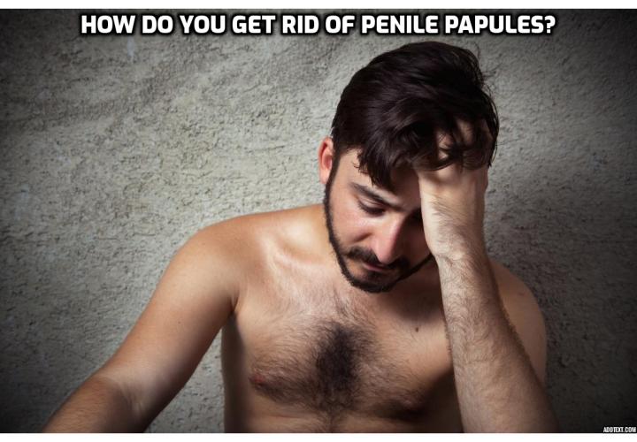 Pearly Penile Papules Home Treatment – How Do You Get Rid of Penile Papules?  Pearly Penile Papules Home Treatment – How Do You Get Rid of Penile Papules?