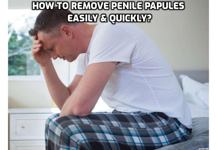 Preventing and Treating Pearly Penile Papules – How to Remove Penile Papules Easily and Quickly?  Preventing and Treating Pearly Penile Papules – Living with pearly penile papules can be a hard and traumatizing experience. Learn how you can get rid of them in an easy and safe way. Read on here to discover the Pearly Penile Papules Natural Home Treatment Program that offers the safest and easiest way to get you rid of those ugly pearly penile papules so that you can forget about those bumps which are so much troubling your life.   