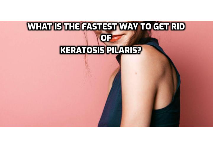 Understanding Keratosis Pilaris – What is the Fastest Way to Get Rid of Keratosis Pilaris?  Understanding Keratosis Pilaris – Although keratosis pilaris is common and usually harmless, you should be sure that you receive an accurate diagnose. Otherwise, treatments may not be effective, and your symptoms may worsen. Because of this, it is important that you avoid making any self-diagnoses of skin conditions; instead, speak with your family doctor or with a dermatologist to ensure that you receive a thorough medical evaluation.
