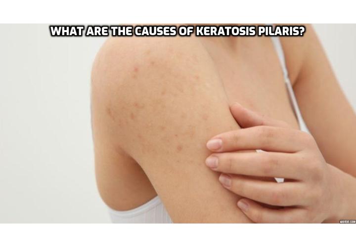 What are the causes of keratosis pilaris? Keratosis pilaris is caused by the buildup of keratin, a protective protein found in your skin. The keratin buildup forms a scaly blockage in the opening of your hair follicles. This blockage involves tiny keratin plugs, which widen the pores and give skin a spotty appearance. 