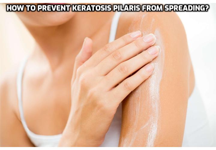 Prevent Keratosis Pilaris – Because keratosis pilaris is associated with dry skin, using a daily moisturizer can create a protective barrier over your skin to prevent water from evaporating. Thicker moisturizers are often the most effective, such as over-the-counter brands Eucerin, CeraVe, and Cetaphil.