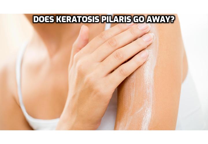 Keratosis Pilaris Treatment – Does Keratosis Pilaris Go Away? Despite the strong genetic influence of keratosis pilaris and the inability to prevent it, following a regular skincare-treatment schedule can reduce your symptoms. Doctors advise using non-soap cleansers, moisturizing regularly with a rich and gentle cream, exfoliating with a gentle pad or cleansing cream, and taking warm showers instead of hot baths. Noticeable results can take weeks to months, so be patient and consistent in your treatment plan.