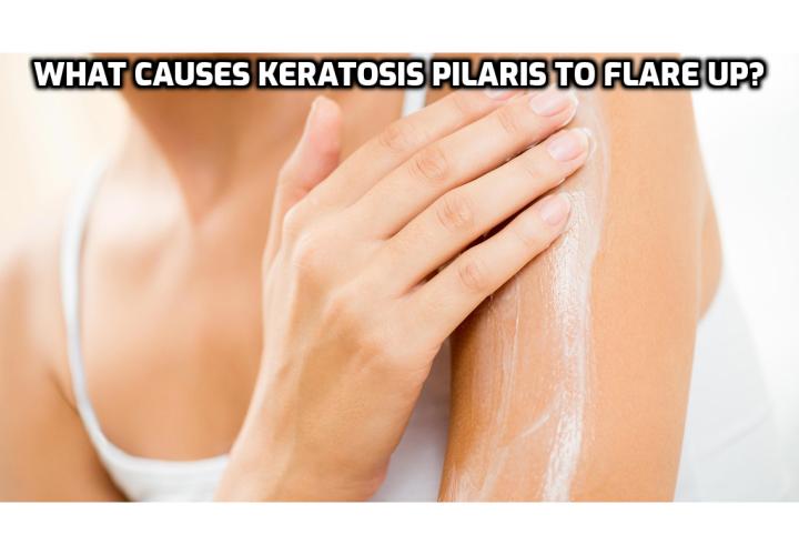 Keratosis Pilaris Causes and Complications – What Causes Keratosis Pilaris to Flare Up?  Any skin condition that involves dryness or moisture loss can contribute to developing keratosis pilaris. Complications involving discoloration are usually the result of changes in the skin's pigment, although this is not common among keratosis pilaris patients. Additionally, superficial scarring can also occur in some individuals with keratosis pilaris.