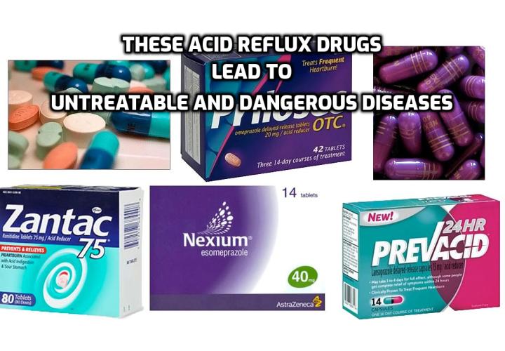 What does acid reflux do to your throat? How long does it take for throat to heal from acid reflux? What is the Best Way to Get Rid of Acid Reflux in Your Throat Fast?