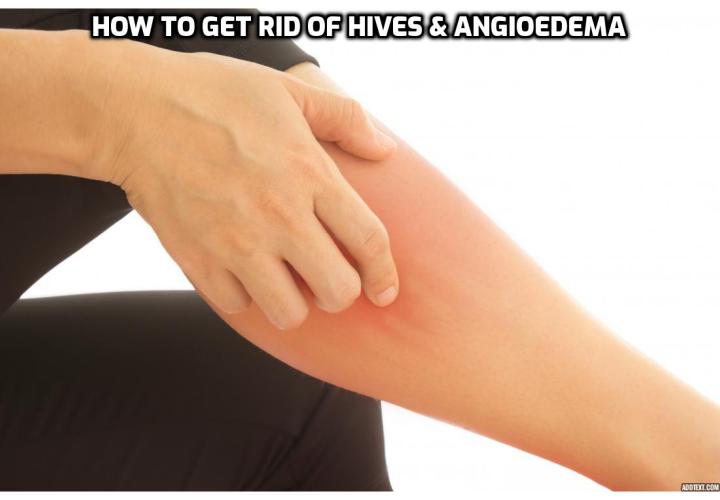 How to get rid of hives and angioedema? The best treatment for hives and angiodema is to identify and remove the trigger, but this is not an easy task. Chronic hives may be treated with antihistamines or a combination of medications. Oral corticosteroids may be prescribed. For severe hives or angioedema,an injection of epinephrine (adrenaline) or a cortisone medication may be needed. In most cases, you can use home remedies, natural remedies and some over-the-counter options to get relief.