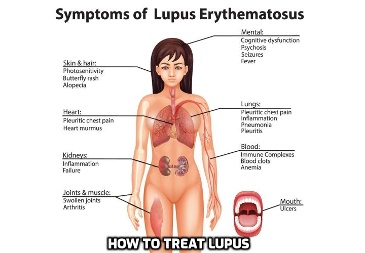 Lupus is one of the most debilitating and discouraging conditions anyone can have. Waking up day after day with joint sores, knowing you are stricken with Lupus that may gradually drag you, a healthy young person, towards chronic illness like rheumatoid arthritis. Read on to discover the various way for treating lupus.