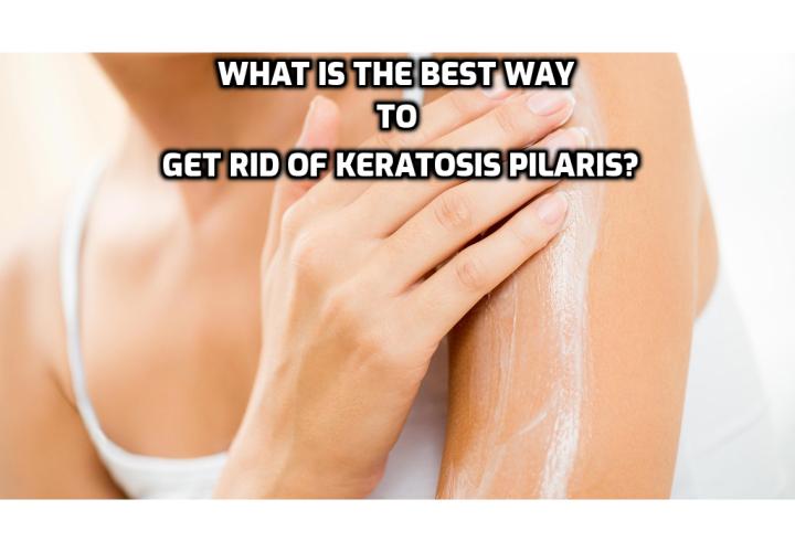 What is the Best Way to Get Rid of Keratosis Pilaris? Read on to learn about the Keratosis Pilaris Remedy program created by Alison White. Keratosis Pilaris Remedy program is a step by step natural system through which you can achieve a smoother and clearer skin in the shortest possible time. It comes with a confidence-boosting skin cleanse that will help you in getting rid of the Keratosis Pilaris condition. 
