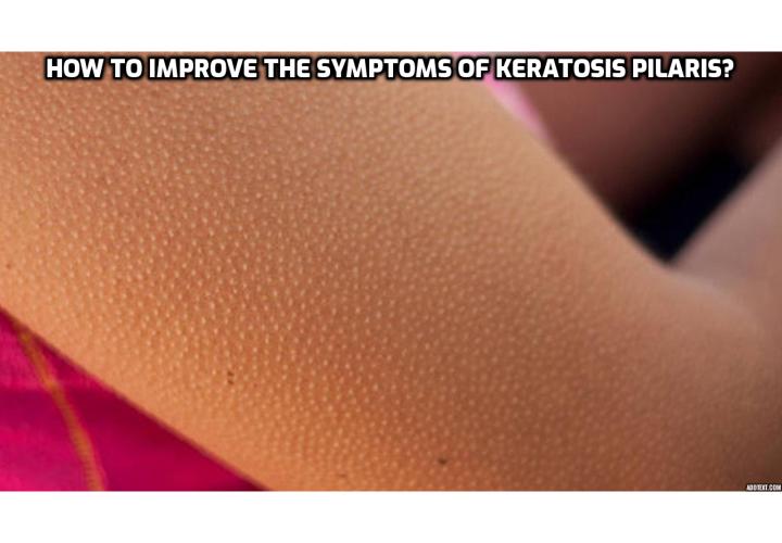 Improve the Symptoms of Keratosis Pilaris - If you feel concerned about your keratosis pilaris, however, see your family doctor or a dermatologist. He or she can suggest additional ways to treat your condition at home, such as using a rich moisturizer on affected skin, exfoliating regularly, and installing a humidifier to keep your home from becoming dry.