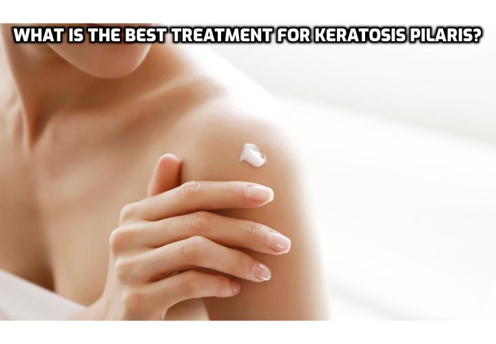 Understanding and Treating Keratosis Pilaris - Because keratosis pilaris is usually a chronic problem that demands long-term maintenance, most treatments that doctors suggest must be used perpetually to maintain results and to reduce symptoms effectively.