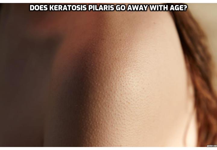 Living with Keratosis Pilaris - Does keratosis pilaris go away with age? If you are concerned about the appearance of your skin, or if you think areas of your skin may be becoming inflamed or irritated, consult your doctor or a dermatologist. He or she can provide an accurate diagnosis based on your symptoms and guide you through the best treatment options. 