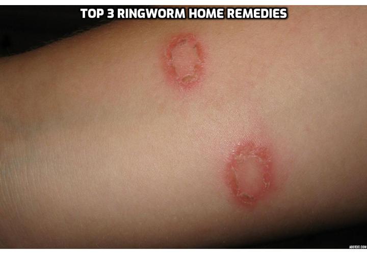 In this article, I will share with you some of the best and most proven Ringworm home remedies that have worked for almost every situation.  It doesn't matter if your cat or dog has Ringworm, your child, or if you have it.  These work for all types of Ringworm, including athlete's foot, jock itch, or the ring-like rash that may be on your scalp or another area of your body.