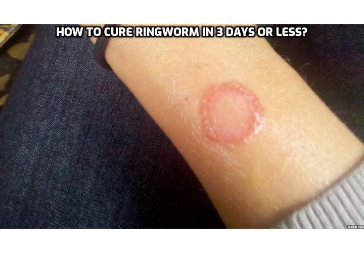 How to Cure Ringworm In 3 Days or Less? In this post, I'm going to share with you how to cure Ringworm in 3 days or less by using these proven methods that have worked for thousands of people around the world with Ringworm.  Not only that, but these same methods work for children, as well as adults, and even pets.  Whether you have athlete's foot or jock it, this will work for you, as those are both types of Ringworm.  