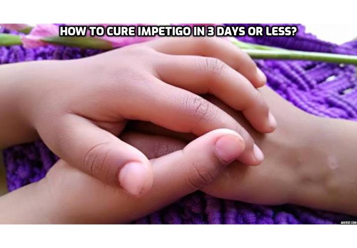 If you’re currently suffering from Impetigo, or your child is, I’m sure you are extremely eager to know how to cure Impetigo as fast as possible.  If you read here, you will find out many easy steps you can take immediately on how to cure Impetigo in less than 3 days.