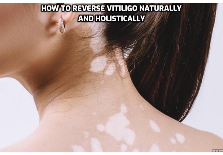 Treatment for vitiligo works better if it started at an early stage (perhaps before 2 or 3 months after starting). If the white spots are developing slowly then we can treat faster than other vitiligo cases. There are measures you can take to reverse vitiligo naturally and prevent it from worsening, including eating a healthy diet. 