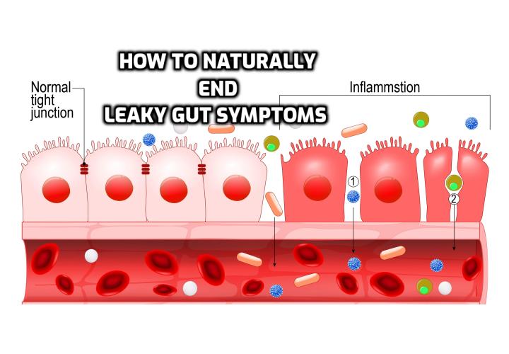 How to naturally end your leaky gut syndrome symptoms permanently? The first step in proper treatment is to determine the primary sources of inflammation that are damaging your intestinal lining. The next is to have a leaky gut diet to restore digestive function. Then you have to restore balance to the gut flora. The final step is to use the right supplements to accelerate the gut healing process.