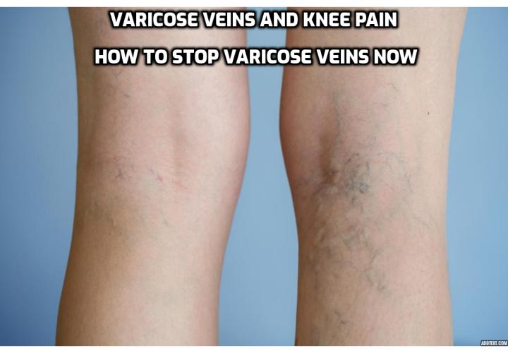 Varicose Veins and Knee Pain – Can varicose veins hurt your knee? Can varicose veins cause swelling knee? How to stop varicose veins now?