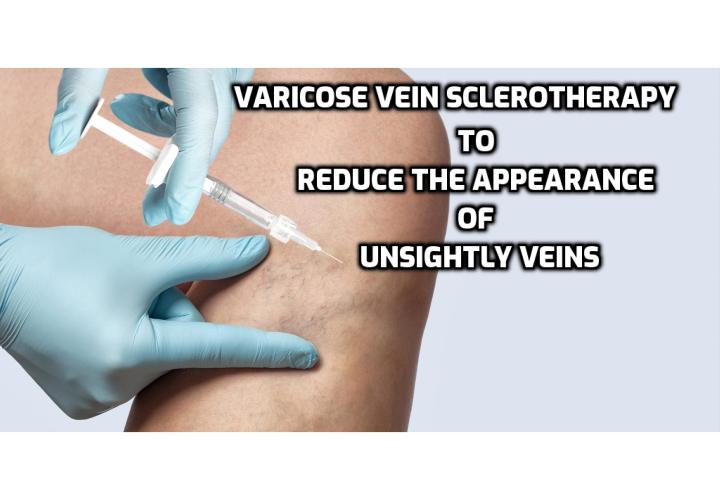 Varicose vein sclerotherapy is a medical technique frequently used to treat small to medium sized varicose veins that is chiefly used to counter the visual, cosmetic symptoms of the condition and works to reduce the appearance of unsightly veins. Read on to find out more. 