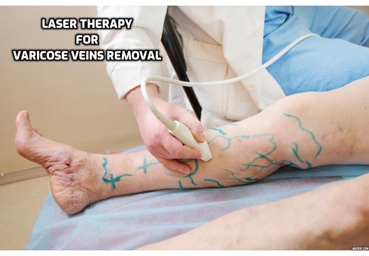 Endovenous Laser Treatment (EVLT) also referred to as Endovenous Ablation Therapy is an effective way of dealing with the cosmetic aspects of varicose veins and a slightly different laser based treatment has proven effective for getting rid of spider veins.