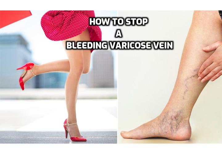 Bleeding Varicose Veins Treatment – In the event that you should be unfortunate enough to experience an accident that results in bleeding varicose veins, follow these simple first aid rules to stop a bleeding varicose vein that may well help you to avoid a tragedy.