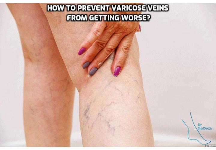 No one wants to get varicose veins and there are a number of ways to prevent varicose veins from getting worse if you have had treatment to repair or remove them. Read on to find out more.