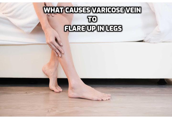 What causes varicose veins to flare up in legs? Some of the causes of varicose veins lie outside a person’s control, however like with so many other conditions, maintaining a healthy weight and staying active can have a genuine preventative effect.