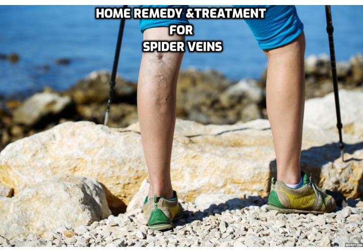 There are a wide number of spider veins natural remedies and it is fair to say that they can also vary widely in their effectiveness. Ultimately when choosing a home remedy of spider veins you may need to try out several until you find a dietary supplement, lotion or lifestyle change that has a positive impact.