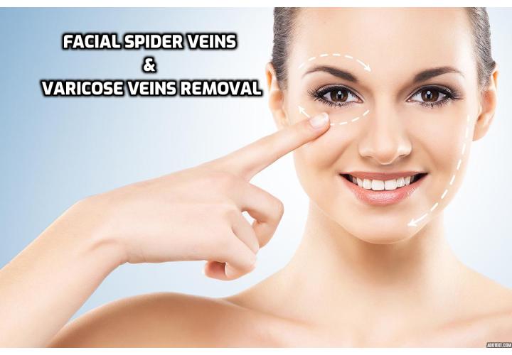 Facial varicose veins are a cosmetic nightmare for sufferers and can be difficult to cope with, as in contrast to varicose veins elsewhere, these cannot be covered up with clothing. What are the facial veins treatments you can consider to remove varicose veins now? Read on to find out more.