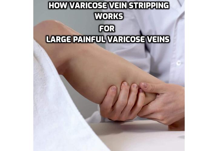 Ligation and stripping involves tying off the affected vein which is then stripped out which means that the other veins in the legs take on the responsibility for carrying the blood around the body.