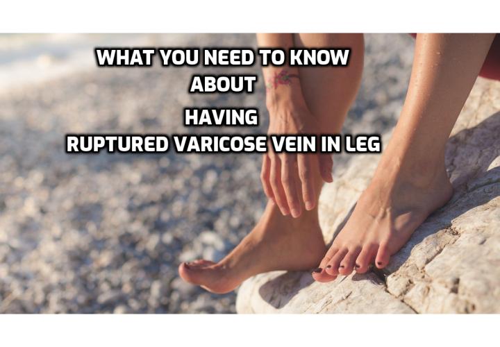 What you need to know about having ruptured varicose vein in leg. Ruptures can also occur spontaneously due to veins being overstretched as a result of excess pressure because of obesity or high blood pressure, or some other condition. When a ruptured varicose vein occurs, here are some essential first aid tips that can prevent more severe consequences like bleeding out occurring. Read on to find out more.