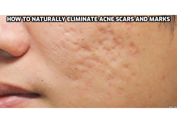 While there’s no denying that the aftermath of a breakout can be messy, there are natural remedies that can help accelerate healing time and fade the marks or acne scars that pimples can cause. Here is how to naturally eliminate acne scars and marks.